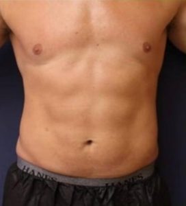 Coolsculpting-resultaat.nl-man-1-na.jpg