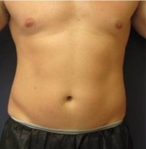 Coolsculpting-resultaat.nl-man-1-voor-1.jpg