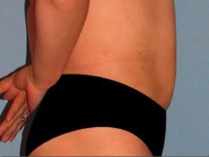 Coolsculpting-resultaat.nl-man-2-na.jpg