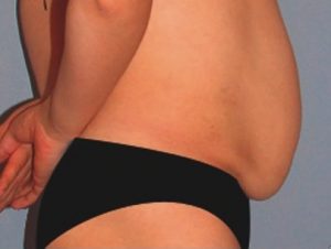 Coolsculpting-resultaat.nl-man-2-voor.jpg