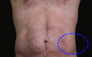 Coolsculpting-resultaat.nl-man-3-na.jpg