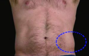 Coolsculpting-resultaat.nl-man-3-voor.jpg