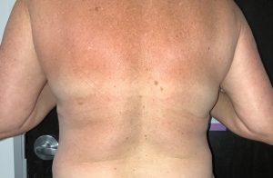 Coolsculpting-resultaat.nl-vrouw-1-rug-na.jpg