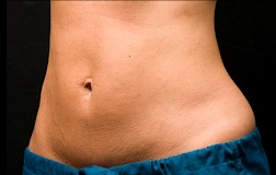 Coolsculpting-resultaat.nl-vrouw-4-buik-na.jpg