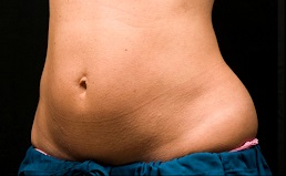 Coolsculpting-resultaat.nl-vrouw-4-buik-voor.jpg